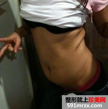 360度环形吸脂减肥瘦腰腹案例图片