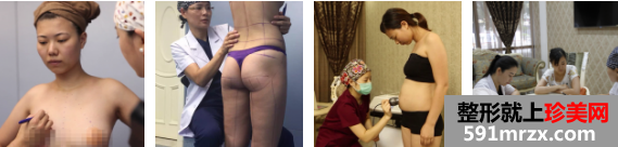 本人自体脂肪丰胸手术3个月前后照片和亲身经历