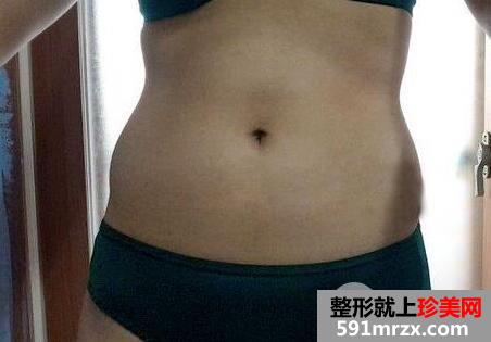 做了吸脂减肥瘦肚子手术效果还不错
