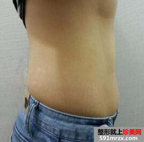 做了吸脂减肥瘦肚子手术效果还不错