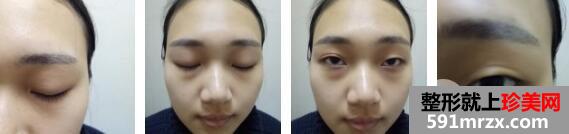 韩式三点双眼皮价格+玻尿酸隆鼻案例