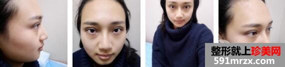 韩式三点双眼皮价格+玻尿酸隆鼻案例