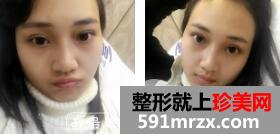 韩式三点双眼皮价格+玻尿酸隆鼻案例