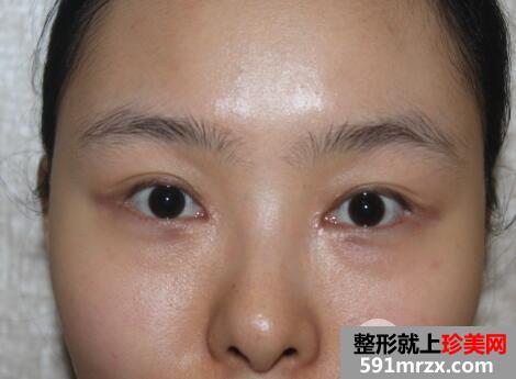 开眼角手术失败修复价格和案例图片