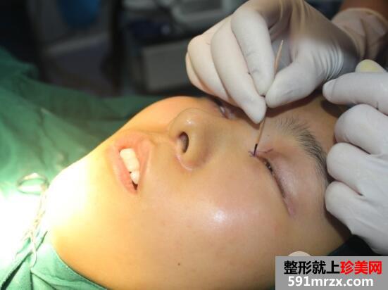 开眼角手术失败修复价格和案例图片