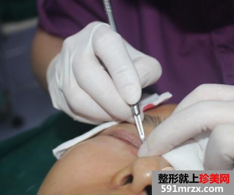 开眼角手术失败修复价格和案例图片