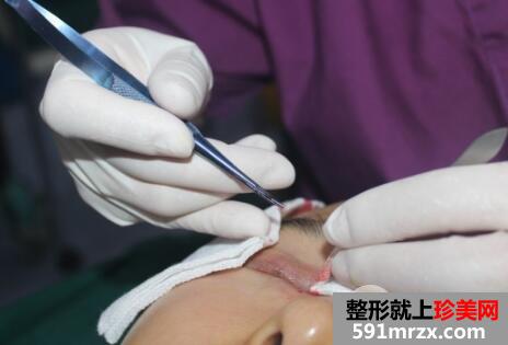 开眼角手术失败修复价格和案例图片