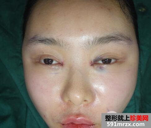 开眼角手术失败修复价格和案例图片