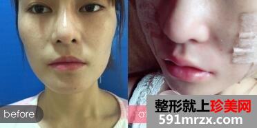 玻尿酸丰唇价格和图片案例