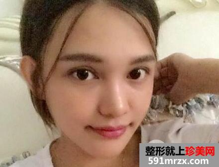 真人玻尿酸丰太阳穴前后照片案例