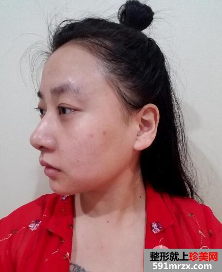 果酸换肤+黑脸娃娃美白嫩肤真实案例