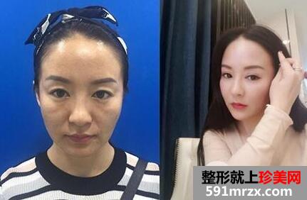 埋线面部提升术价格和案例分享