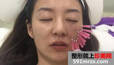 埋线面部提升术价格和案例分享