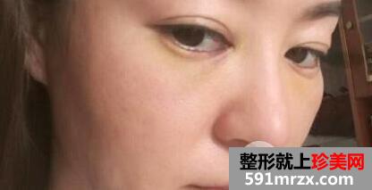 埋线面部提升术价格和案例分享
