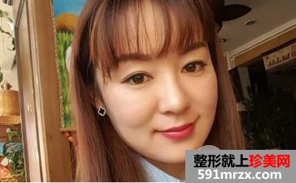 埋线面部提升术价格和案例分享