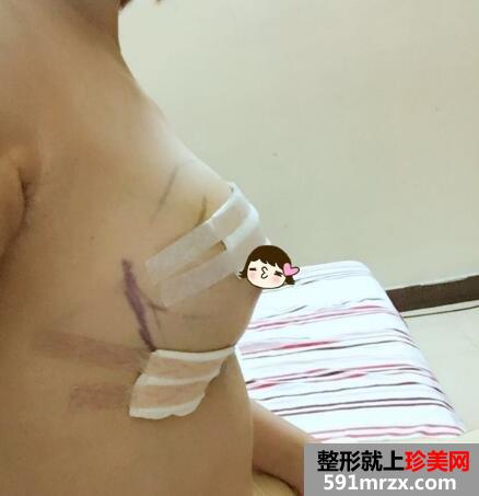 北京禾美嘉自体填充丰胸价格案例