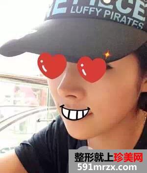 成都武侯素美天资做的耳软骨隆鼻手术，两年了效果依旧