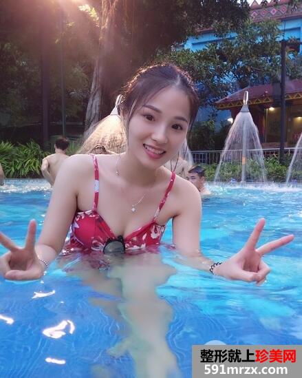 自体脂肪填充丰胸医院北京禾美嘉案例