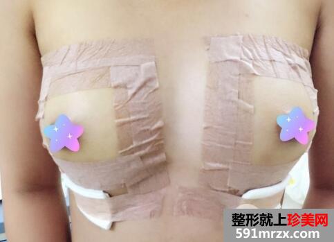 自体脂肪填充丰胸医院北京禾美嘉案例