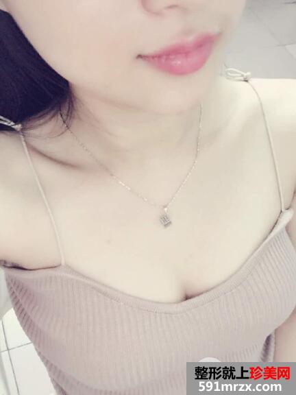 自体脂肪填充丰胸医院北京禾美嘉案例