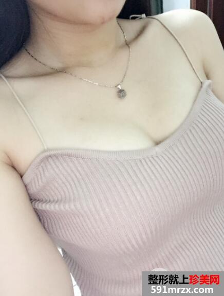 自体脂肪填充丰胸医院北京禾美嘉案例