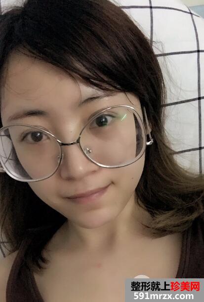 北京东方和谐整形冯斌自体脂肪面部填充价格案例