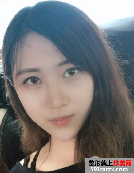 北京东方和谐整形冯斌自体脂肪面部填充价格案例