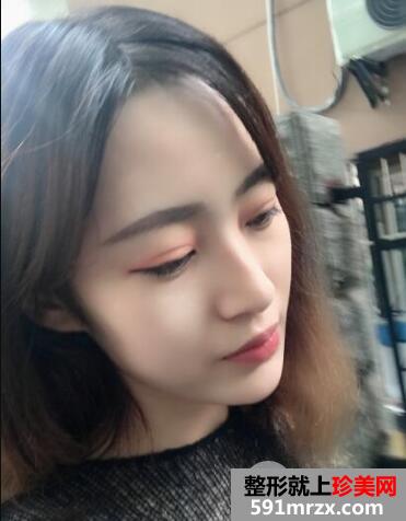 北京东方和谐整形冯斌自体脂肪面部填充价格案例