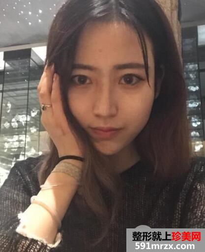 北京东方和谐整形冯斌自体脂肪面部填充价格案例