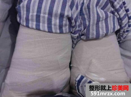 成都自体脂肪移植丰胸医院玉之光价格案例