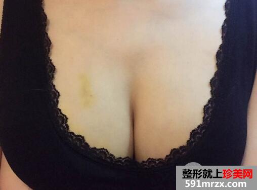 成都自体脂肪移植丰胸医院玉之光价格案例