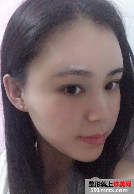 北京禾美嘉丰太阳穴多少钱?自体脂肪填充太阳穴案例