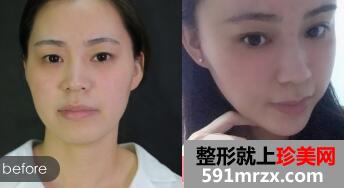 北京禾美嘉丰太阳穴多少钱?自体脂肪填充太阳穴案例