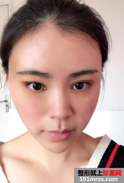 北京禾美嘉丰太阳穴多少钱?自体脂肪填充太阳穴案例