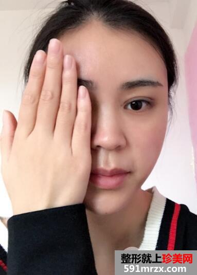 北京禾美嘉丰太阳穴多少钱?自体脂肪填充太阳穴案例