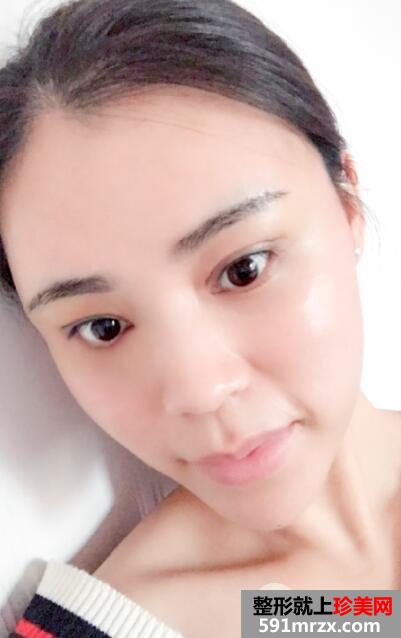 北京禾美嘉丰太阳穴多少钱?自体脂肪填充太阳穴案例