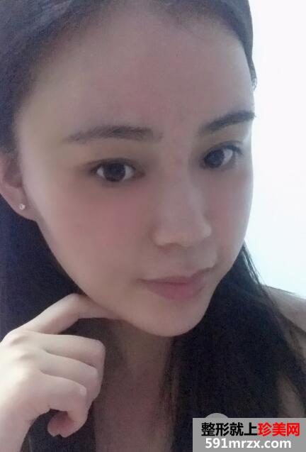 北京禾美嘉丰太阳穴多少钱?自体脂肪填充太阳穴案例