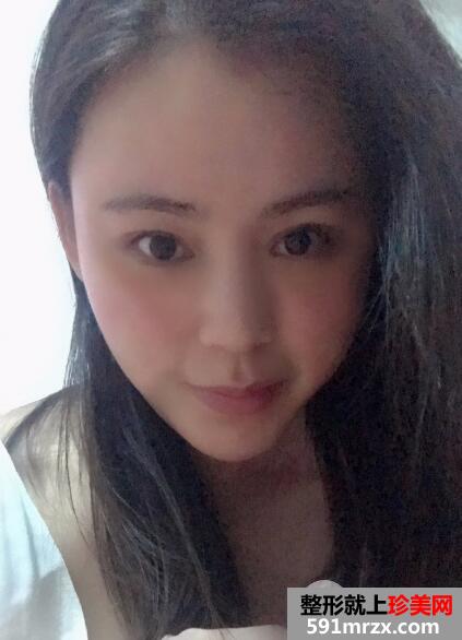 北京禾美嘉丰太阳穴多少钱?自体脂肪填充太阳穴案例