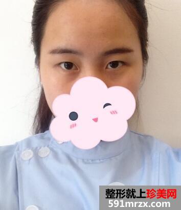 北京禾美嘉赵海成整形专家埋线双眼皮案例