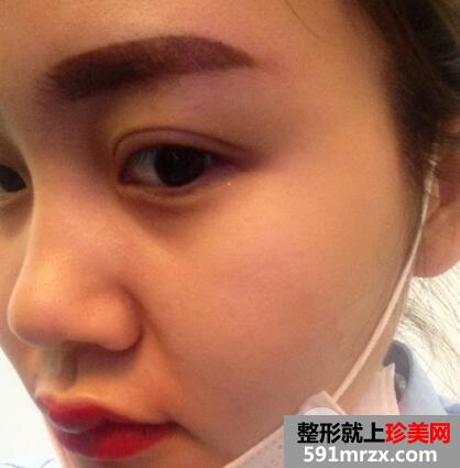 北京禾美嘉赵海成整形专家埋线双眼皮案例