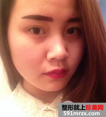 北京禾美嘉赵海成整形专家埋线双眼皮案例