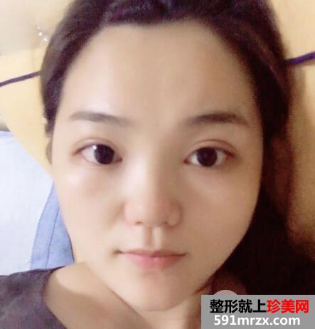 切开双眼皮和开内眼角眼综合整形恢复过程案例