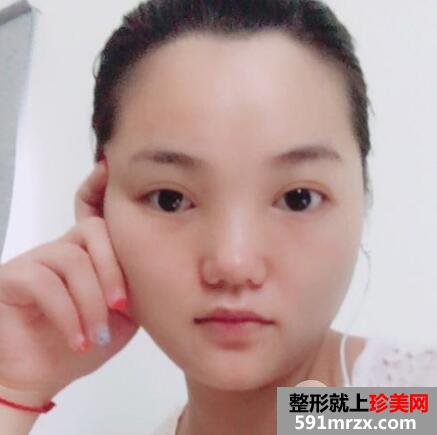 切开双眼皮和开内眼角眼综合整形恢复过程案例