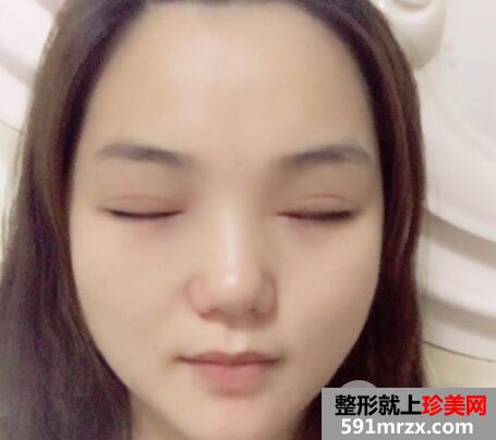 切开双眼皮和开内眼角眼综合整形恢复过程案例