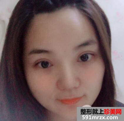 切开双眼皮和开内眼角眼综合整形恢复过程案例