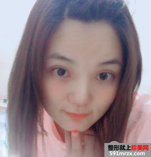 切开双眼皮和开内眼角眼综合整形恢复过程案例