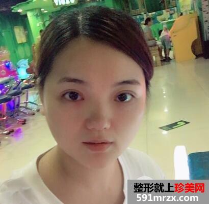 切开双眼皮和开内眼角眼综合整形恢复过程案例