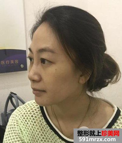 切开双眼皮价格5860元恢复一周效果图案例