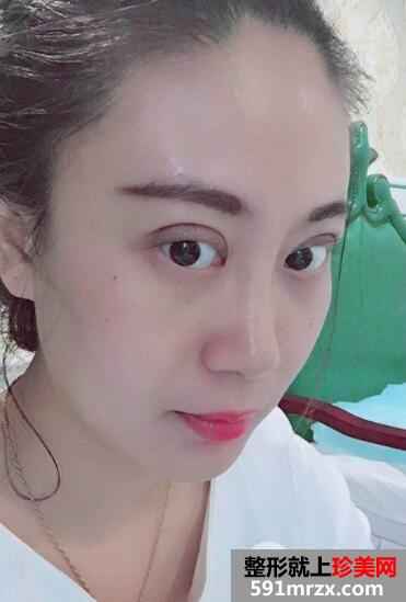 切开双眼皮价格5860元恢复一周效果图案例