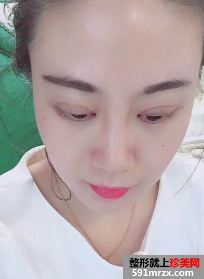 切开双眼皮价格5860元恢复一周效果图案例